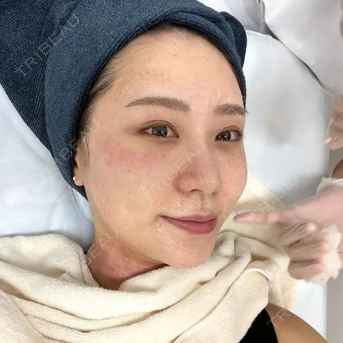 水光注射（ハリ・美肌） STARS CLINIC DAY 0 メイン用