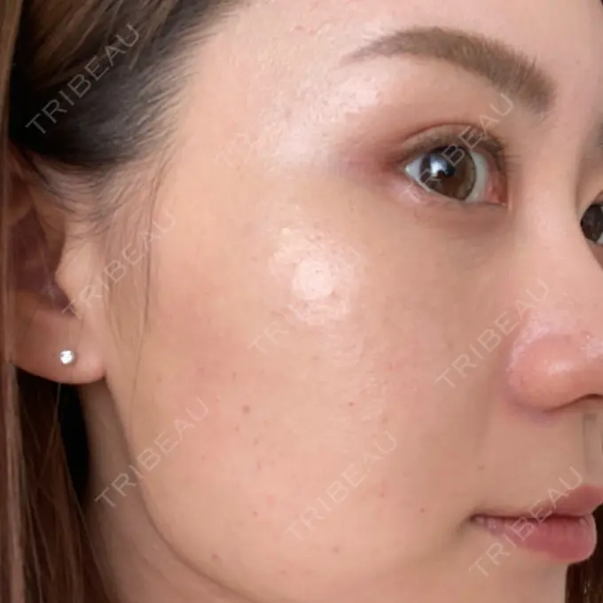 水光注射（ハリ・美肌） STARS CLINIC DAY 0 メイン用