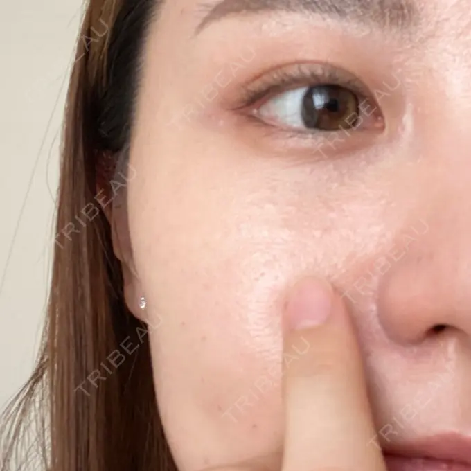 水光注射（ハリ・美肌） STARS CLINIC DAY 0 メイン用