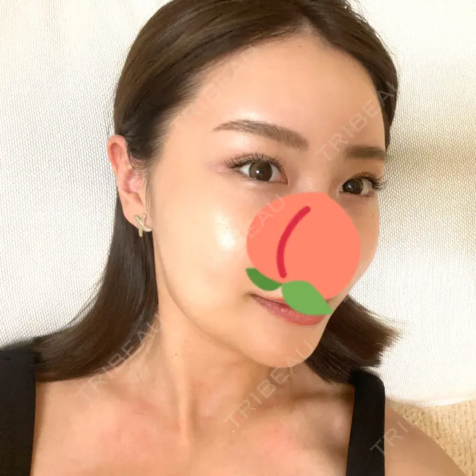 水光注射（ハリ・美肌） STARS CLINIC DAY 8 メイン用