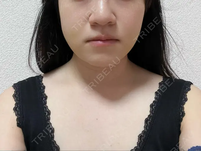 脂肪吸引（顔） THE CLINIC（ザ・クリニック） 福岡院 DAY 7 メイン用