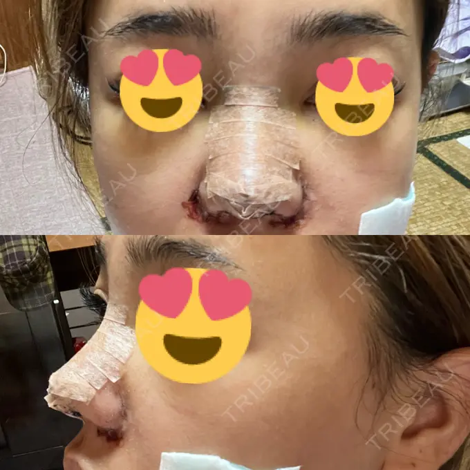 鼻中隔延長（切開） / 眉間プロテーゼ / 鼻尖縮小 / 鼻尖形成（非切開） YBC横浜美容外科 大宮院 DAY 3 メイン用