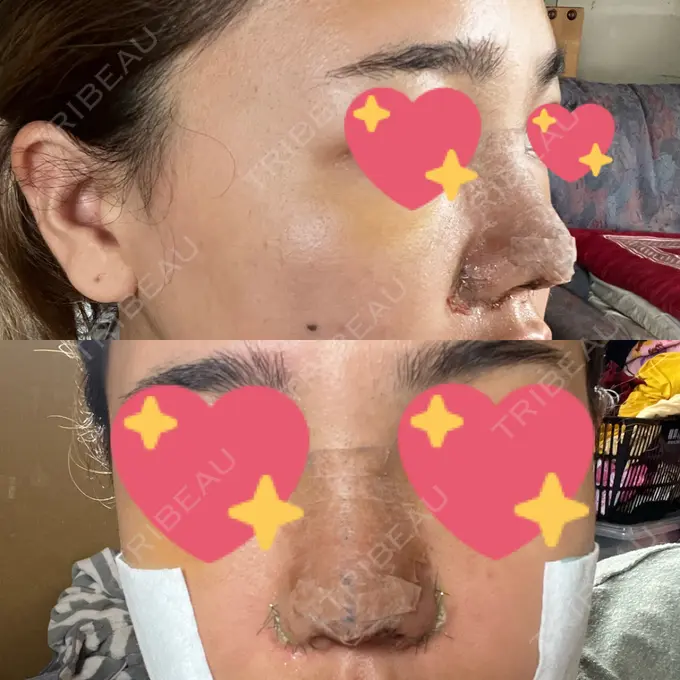 鼻中隔延長（切開） / 眉間プロテーゼ / 鼻尖縮小 / 鼻尖形成（非切開） YBC横浜美容外科 大宮院 DAY 4 メイン用