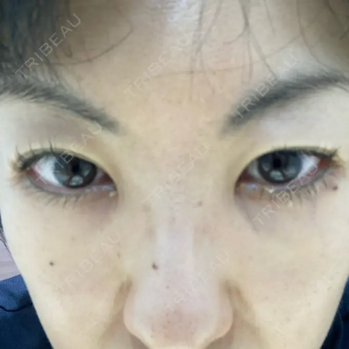 下まぶたたるみ取り 吉井クリニック DAY 3 メイン用