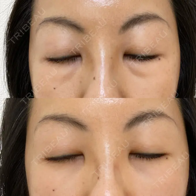 下まぶたたるみ取り 吉井クリニック DAY 3 メイン用