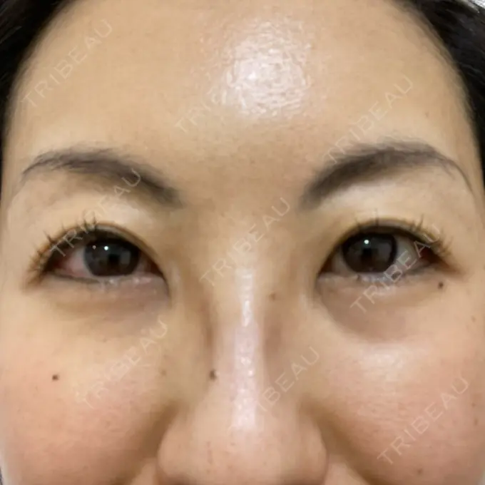 下まぶたたるみ取り 吉井クリニック DAY 4 メイン用