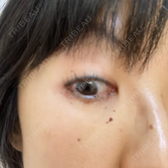 下まぶたたるみ取り 吉井クリニック DAY 6 メイン用