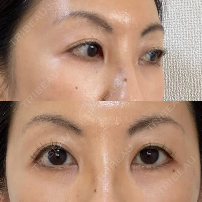 下まぶたたるみ取り 吉井クリニック DAY 10 メイン用