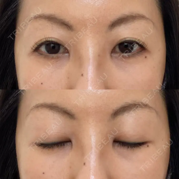 下まぶたたるみ取り 吉井クリニック AFTER メイン用