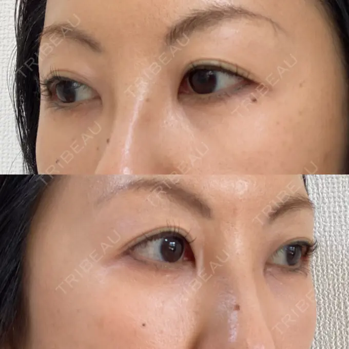 下まぶたたるみ取り 吉井クリニック DAY 17 メイン用