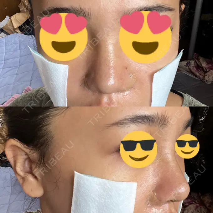 鼻中隔延長（切開） / 眉間プロテーゼ / 鼻尖縮小 / 鼻尖形成（非切開） YBC横浜美容外科 大宮院 DAY 5 メイン用