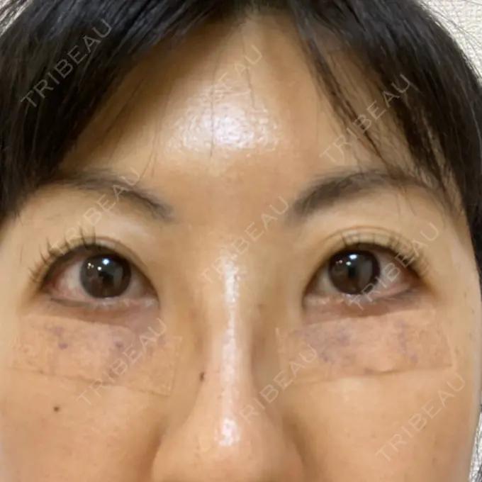 下まぶたたるみ取り 吉井クリニック DAY 2 メイン用