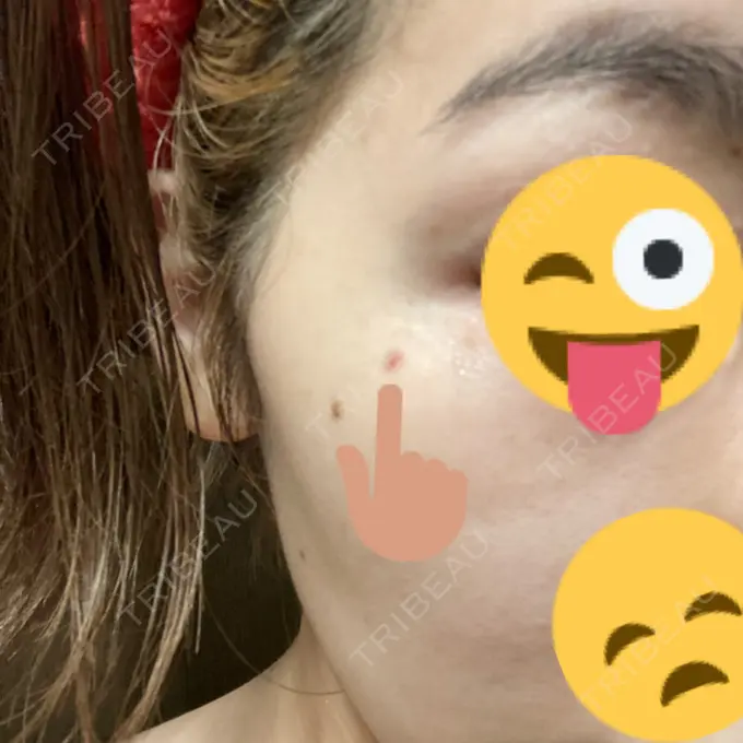 シミ取りレーザー 渋谷美容外科クリニック 渋谷院 DAY 0 メイン用