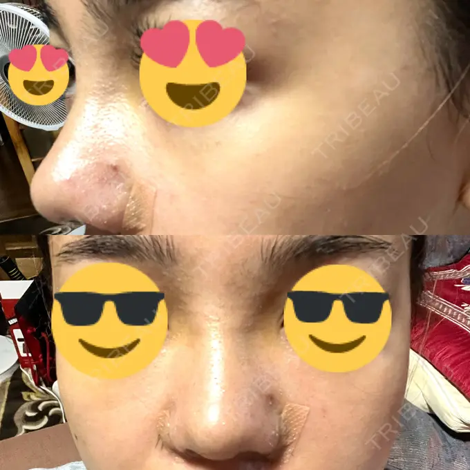 鼻中隔延長（切開） / 眉間プロテーゼ / 鼻尖縮小 / 鼻尖形成（非切開） YBC横浜美容外科 大宮院 DAY 6 メイン用