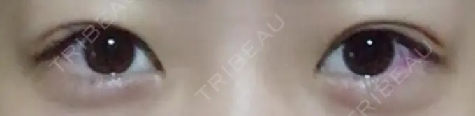 二重埋没 品川スキンクリニック広島院 DAY 44 メイン用