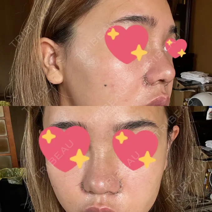 鼻中隔延長（切開） / 眉間プロテーゼ / 鼻尖縮小 / 鼻尖形成（非切開） YBC横浜美容外科 大宮院 DAY 7 メイン用