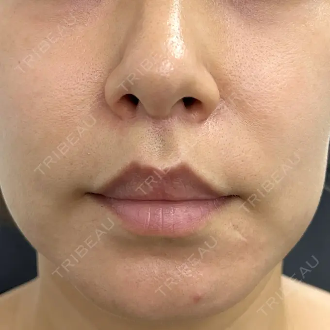 人中短縮 新宿ラクル美容外科クリニック 新宿院 AFTER メイン用