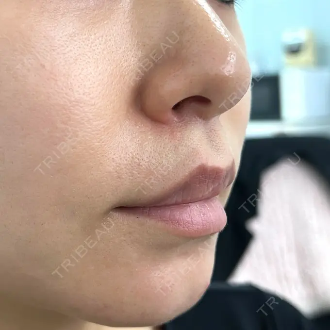 人中短縮 新宿ラクル美容外科クリニック 新宿院 DAY 163 メイン用