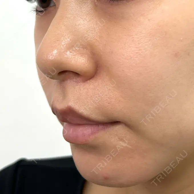 人中短縮 新宿ラクル美容外科クリニック 新宿院 DAY 163 メイン用