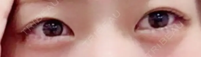 二重埋没 品川スキンクリニック広島院 DAY 71 メイン用