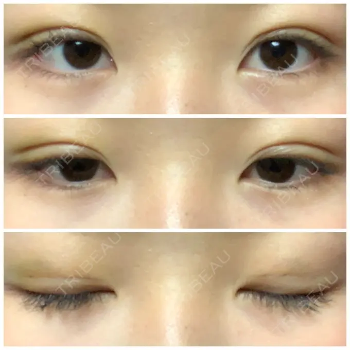 二重埋没 湘南美容クリニック 長野院 DAY 5 メイン用