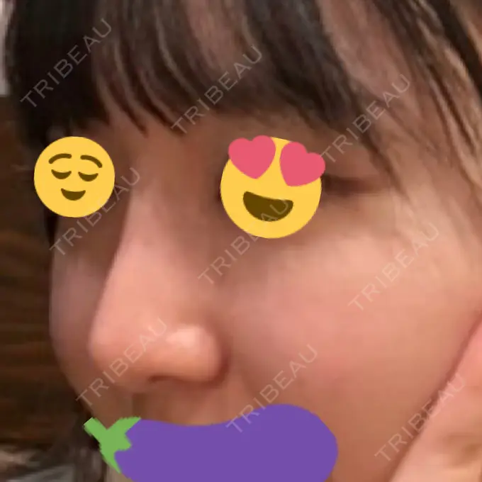 隆鼻術 ヤスミクリニック AFTER メイン用