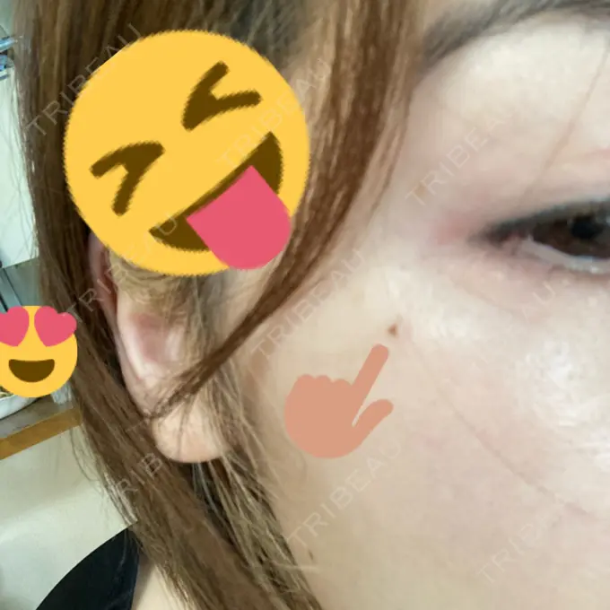 シミ取りレーザー 渋谷美容外科クリニック 渋谷院 DAY 4 メイン用