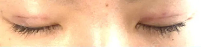 二重埋没 大塚美容形成外科 金沢院 DAY 1 メイン用