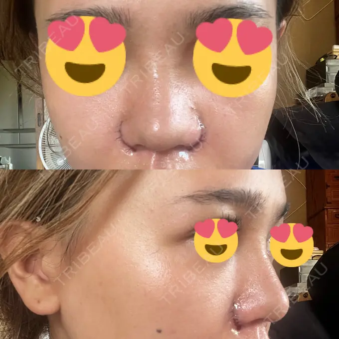 鼻中隔延長（切開） / 眉間プロテーゼ / 鼻尖縮小 / 鼻尖形成（非切開） YBC横浜美容外科 大宮院 DAY 7 メイン用