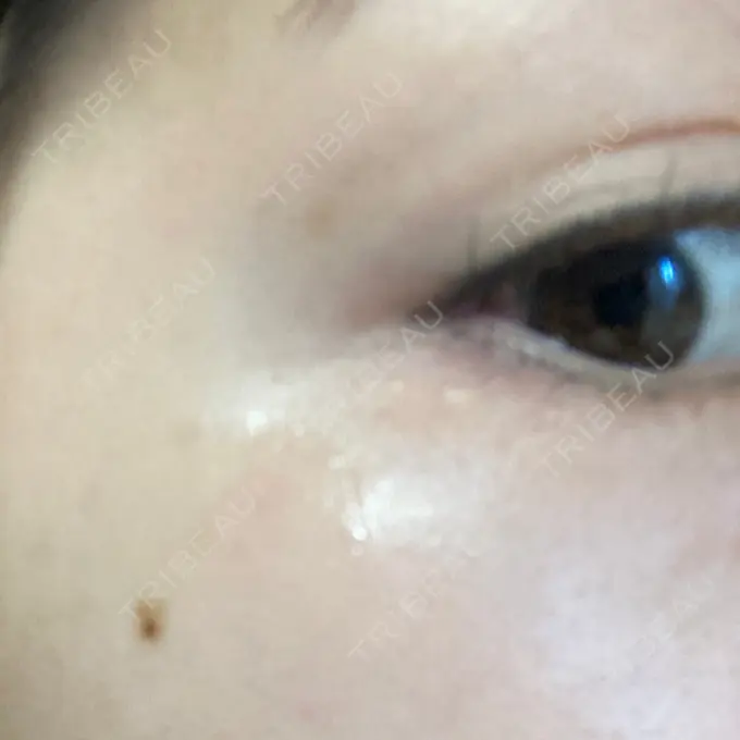 シミ取りレーザー 渋谷美容外科クリニック 渋谷院 DAY 4 メイン用