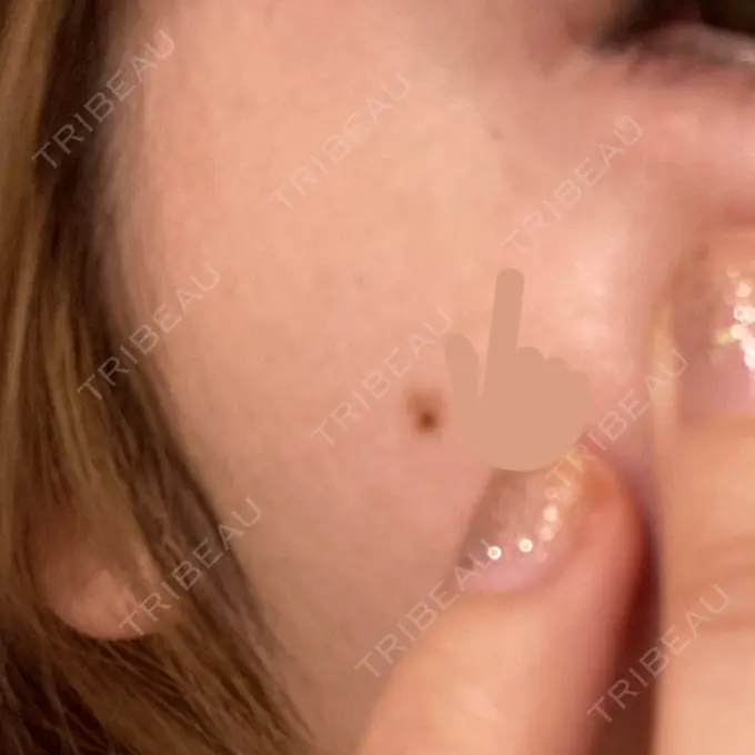 シミ取りレーザー 渋谷美容外科クリニック 渋谷院 AFTER メイン用