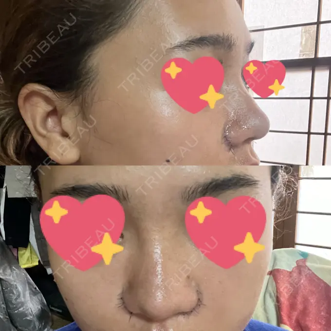 鼻中隔延長（切開） / 眉間プロテーゼ / 鼻尖縮小 / 鼻尖形成（非切開） YBC横浜美容外科 大宮院 DAY 10 メイン用