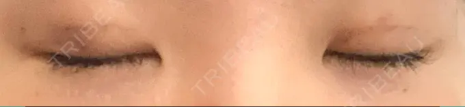 二重埋没 大塚美容形成外科 金沢院 DAY 2 メイン用