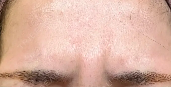 ボトックス（眉間） / ボトックス（額） / その他（鼻） TCB東京中央美容外科 郡山院 DAY 0 メイン用