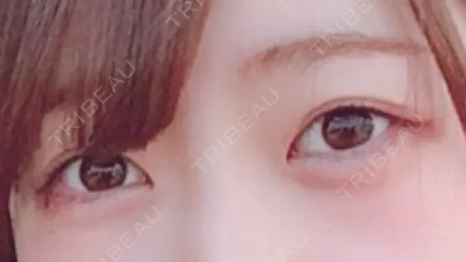 二重埋没 品川スキンクリニック広島院 DAY 181 メイン用