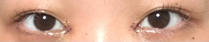 目頭切開 くさのたろうクリニック DAY 4 メイン用