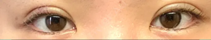 二重埋没 大塚美容形成外科 金沢院 DAY 4 メイン用