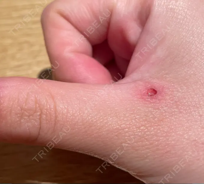 ほくろ・いぼ切除（肌） 吉祥寺アイビークリニック DAY 2 メイン用