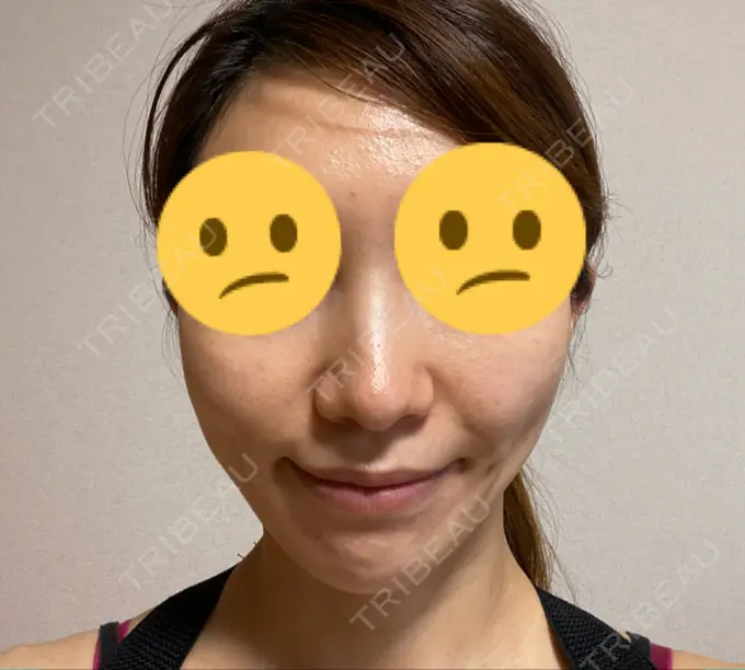 メーラーファット除去 ガーデンクリニック 名古屋院 DAY 94 メイン用