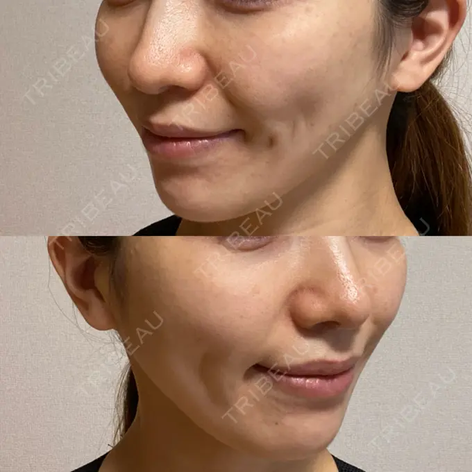 メーラーファット除去 ガーデンクリニック 名古屋院 DAY 94 メイン用