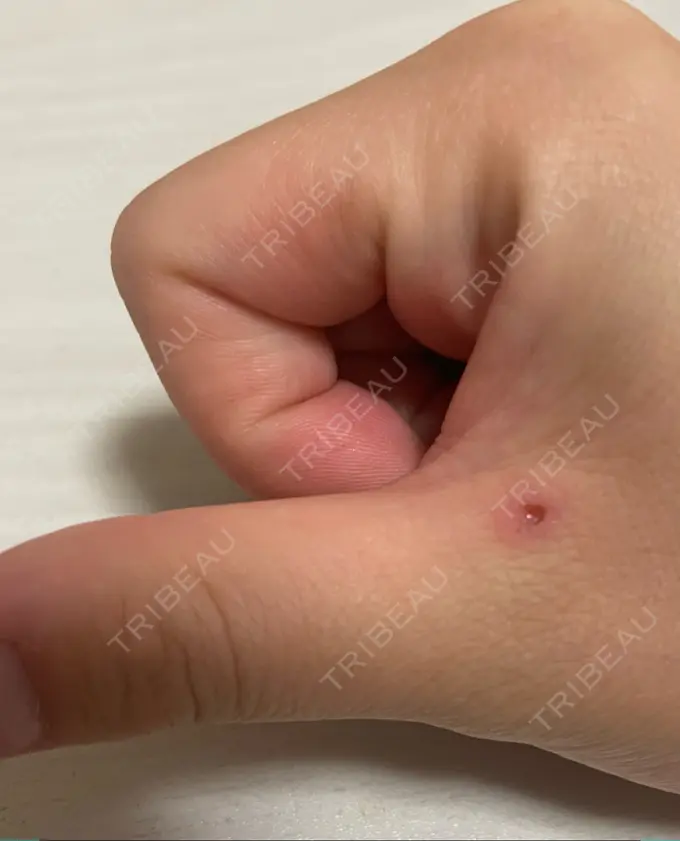 ほくろ・いぼ切除（肌） 吉祥寺アイビークリニック DAY 3 メイン用