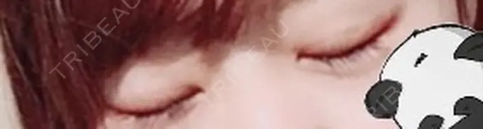 二重埋没 品川スキンクリニック広島院 DAY 181 メイン用