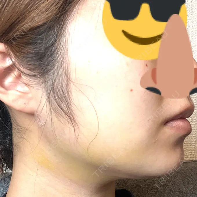 糸リフト / 脂肪吸引（顔） 東京シンデレラ美容外科 池袋院 DAY 7 メイン用