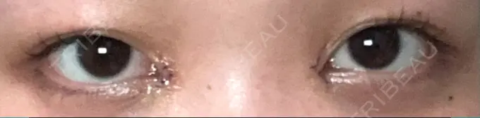 目頭切開 くさのたろうクリニック DAY 5 メイン用