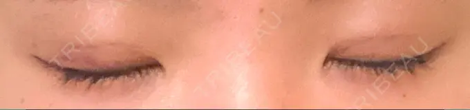 二重埋没 大塚美容形成外科 金沢院 DAY 5 メイン用