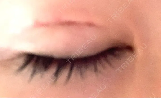 二重埋没 十仁美容整形 DAY 2 メイン用