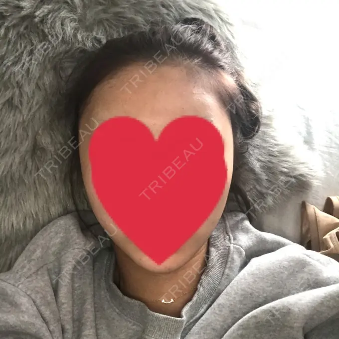 バッカルファット除去 / 脂肪吸引（顔） / 額を丸く / ヒアルロン酸注入（あご） / ボトックス（エラ・小顔） / ヒアルロン酸注入（額） エートップ美容整形外科 DAY 11 メイン用