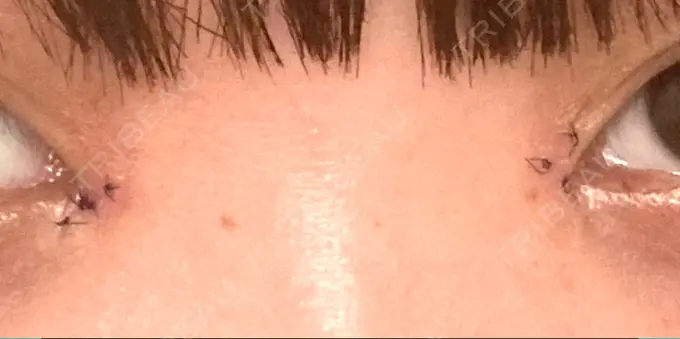 目頭切開 くさのたろうクリニック DAY 7 メイン用