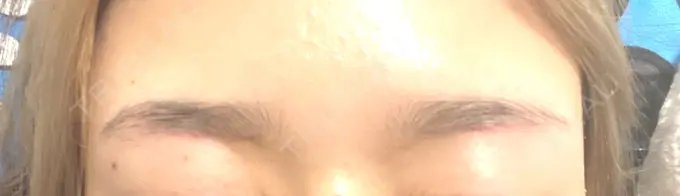 上まぶたの脂肪取り / 眉下切開 e:Top clinic（イートップクリニック） DAY 55 メイン用