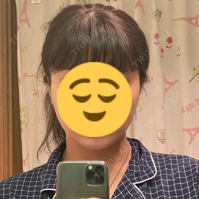 ボトックス（エラ・小顔） / ボトックス（肩） TCB東京中央美容外科 川口院 DAY 1 メイン用